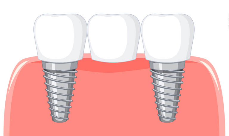 Dental bridges in Gurgaon at Muskaan Dentals
