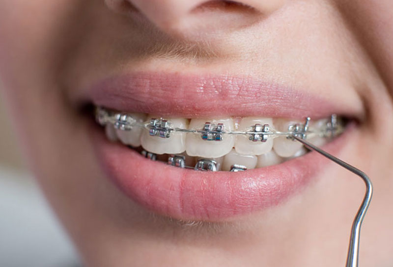 Orthodontic braces in Gurgaon at Muskaan Dentals