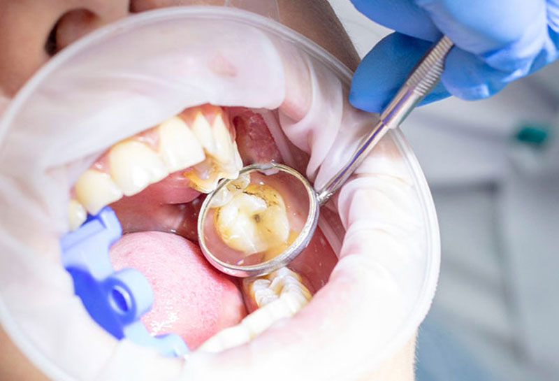 GIC dental filling in Gurgaon at Muskaan Dentals