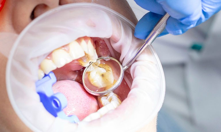 GIC filling in Gurgaon at Muskaan Dentals — glass ionomer cement dental filling by Dr. Suresh Ahlawat
