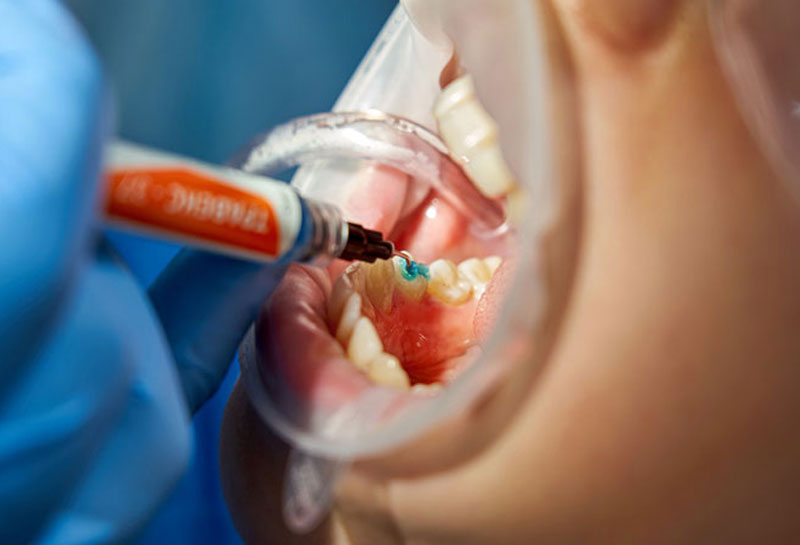 Teeth cleaning (scaling) in Gurgaon at Muskaan Dentals