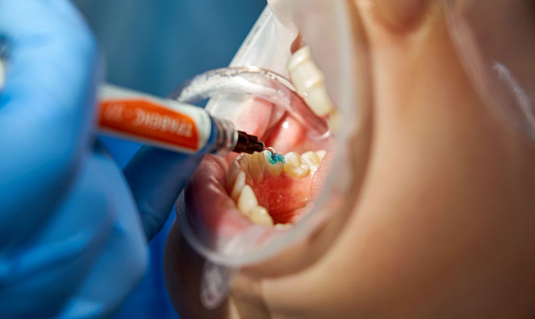 Teeth cleaning in Gurgaon at Muskaan Dentals — professional scaling and polishing by hygienist team