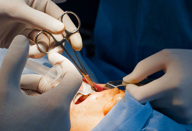 Tooth extraction in Gurgaon at Muskaan Dentals