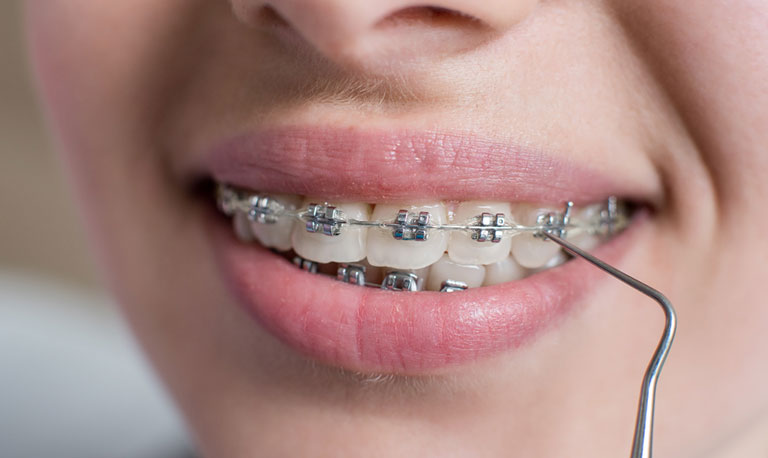 Braces dentist in Gurgaon at Muskaan Dentals — metal, ceramic, and lingual braces orthodontic treatment