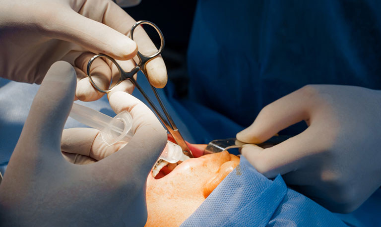 Tooth extraction in Gurgaon at Muskaan Dentals — painless dental extraction by Dr. Suresh Ahlawat