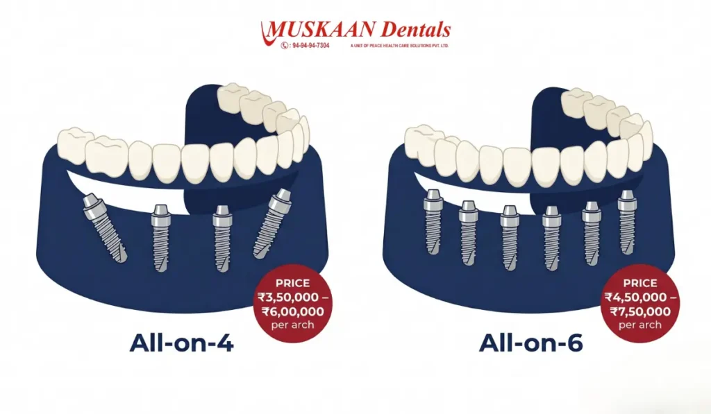 All-on-4 and All-on-6 full mouth dental implants cost Gurgaon — Muskaan Dentals