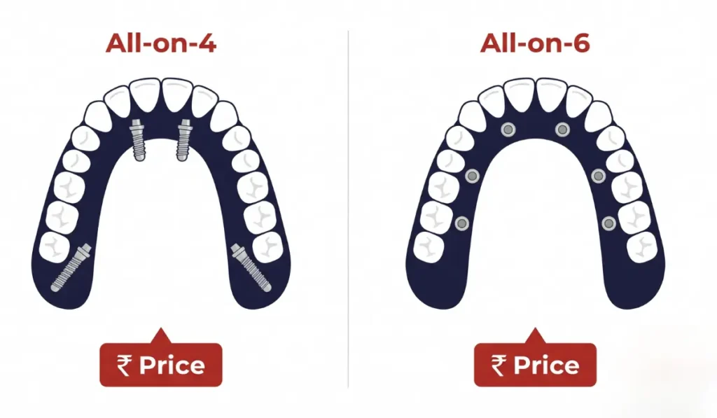 All-on-4 vs All-on-6 full arch implants diagram Gurgaon — Muskaan Dentals