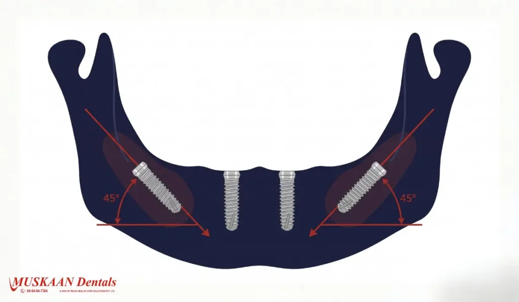 All-on-4 implant angulation diagram showing 4 implants in jawbone — Muskaan Dentals Gurgaon