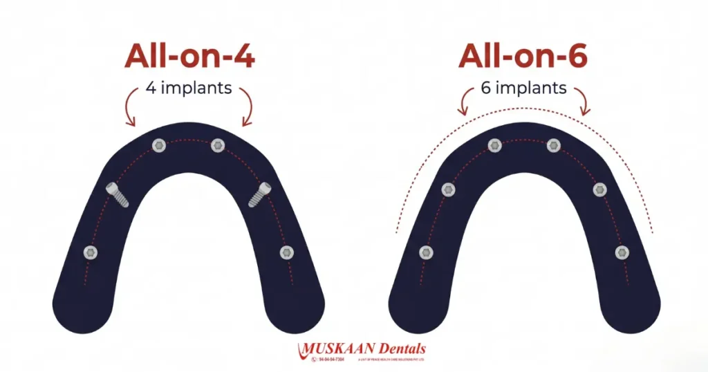 All-on-4 vs All-on-6 implant comparison diagram — Muskaan Dentals Gurgaon