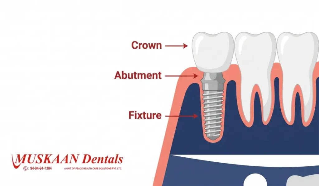 single tooth implant components diagram fixture abutment crown — Muskaan Dentals Gurgaon