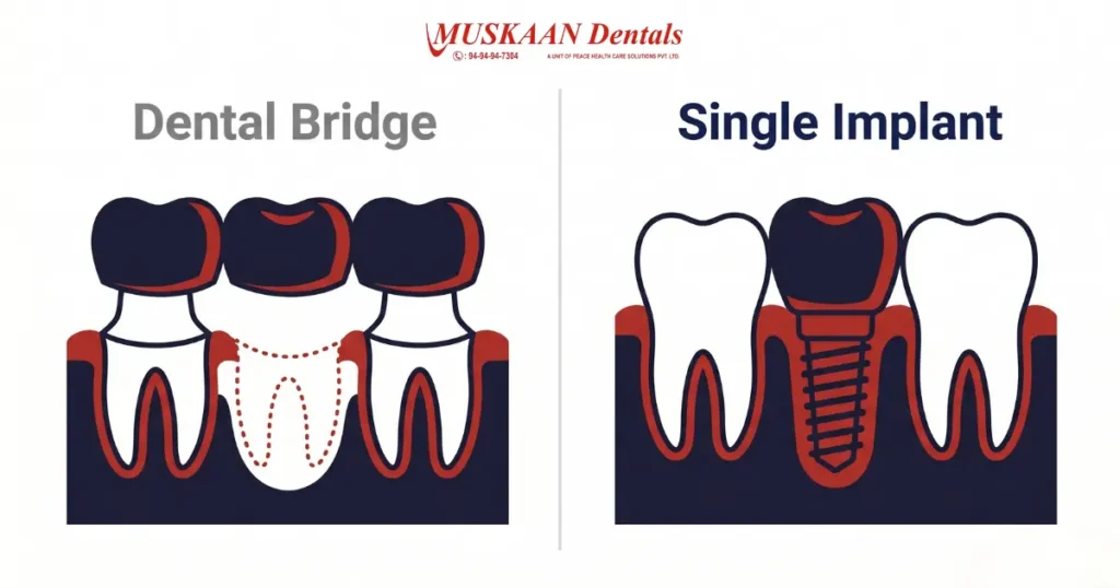single tooth implant vs dental bridge comparison Gurgaon — Muskaan Dentals
